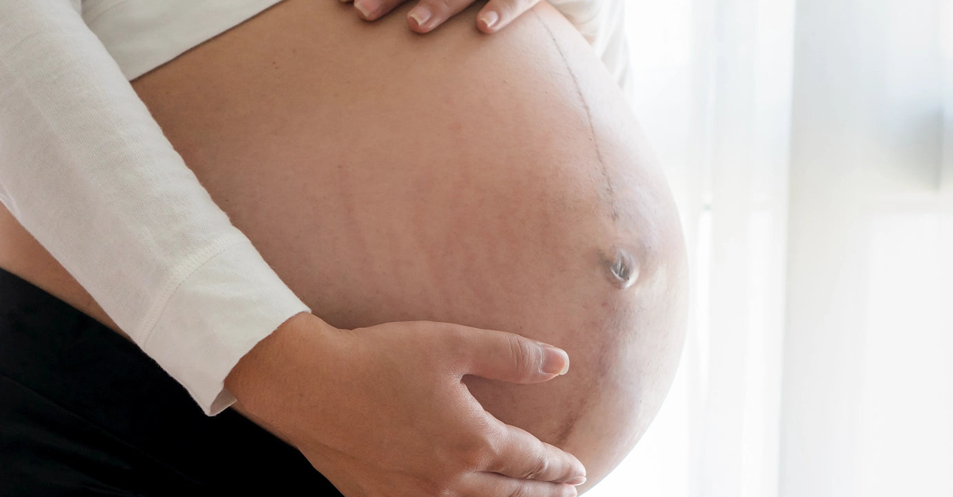 after the stretch marks removal cream