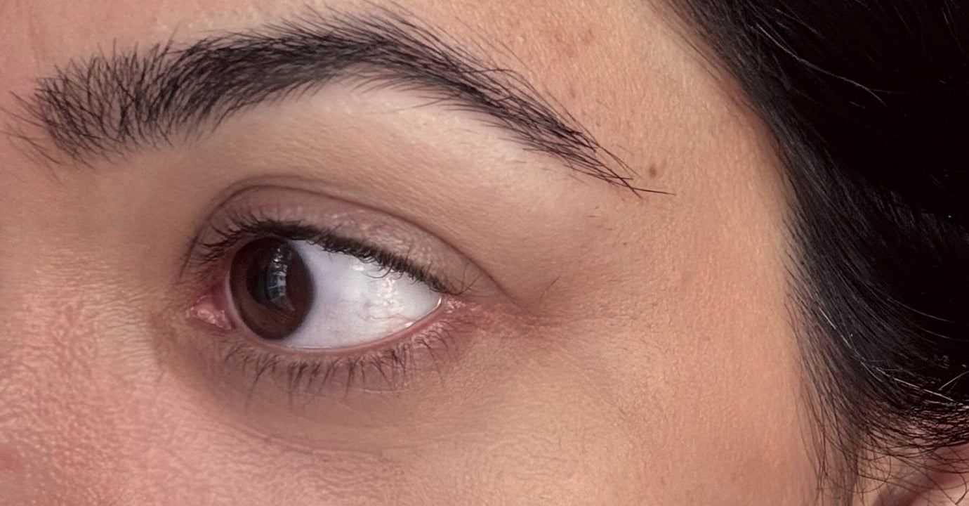 After applying Dark circles removal cream