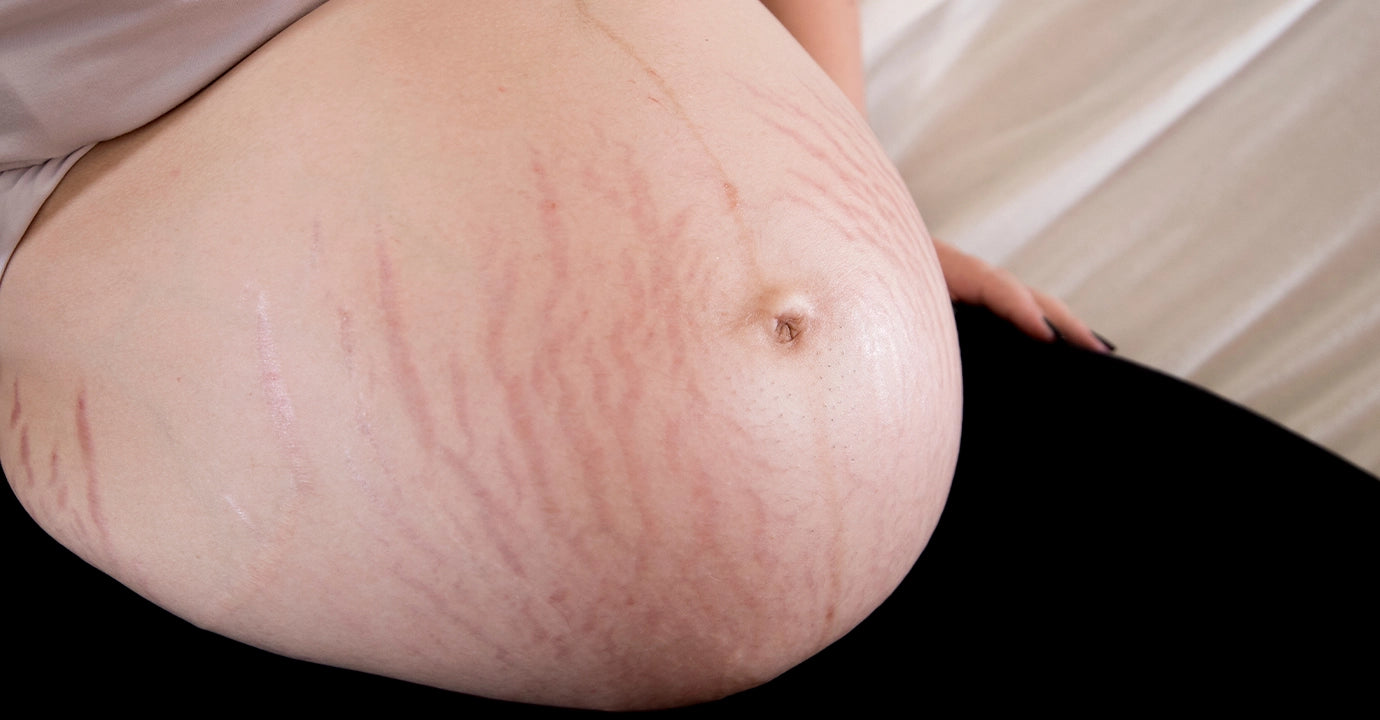 Before Stretch mark cream