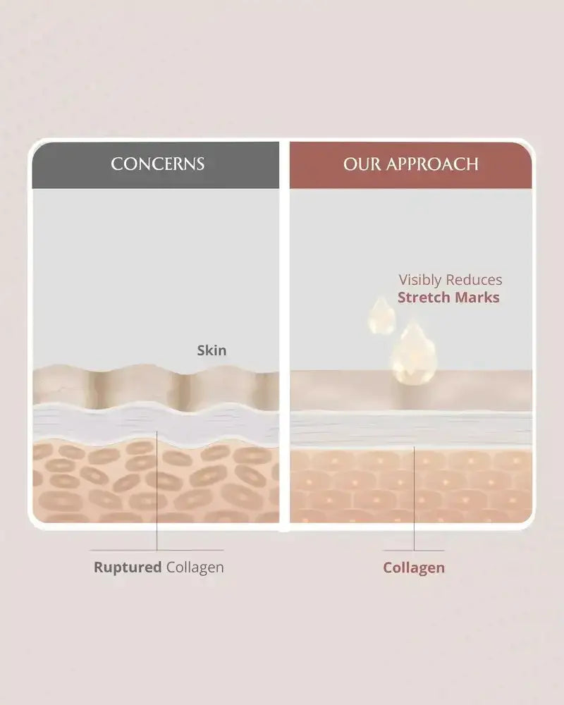 Diagram showing skin with ruptured collagen and the product's approach to visibly reduce stretch marks.