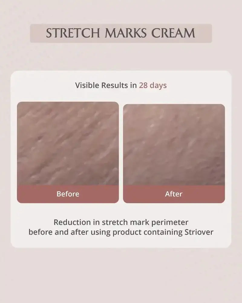 Before and after comparison of stretch marks using a cream, with text indicating visible results in 28 days.
