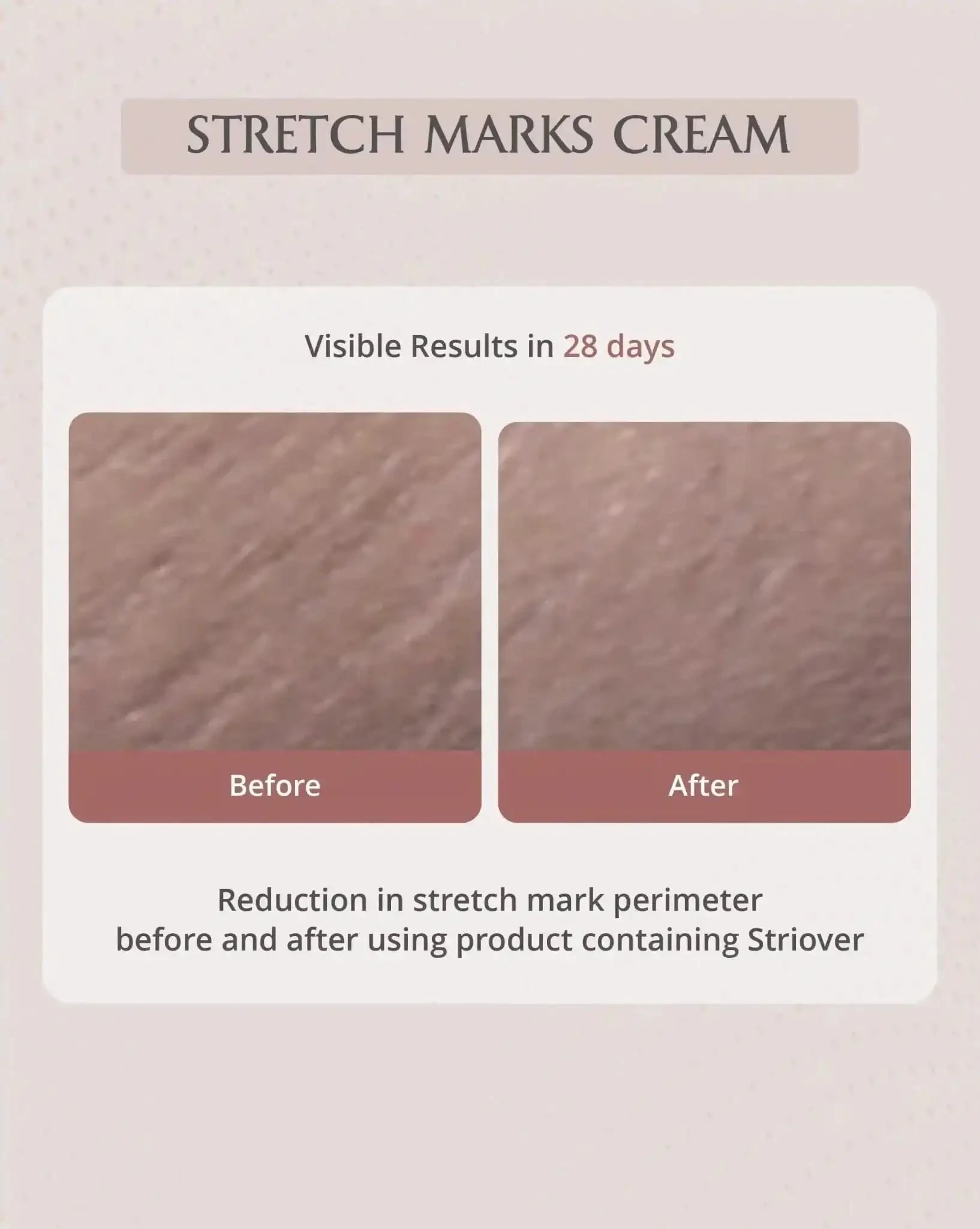 AreoVeda Stretch Mark Cream - visible results in 28 days