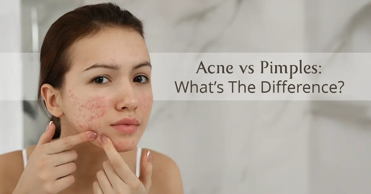 Acne Vs Pimples: What’s The Difference?