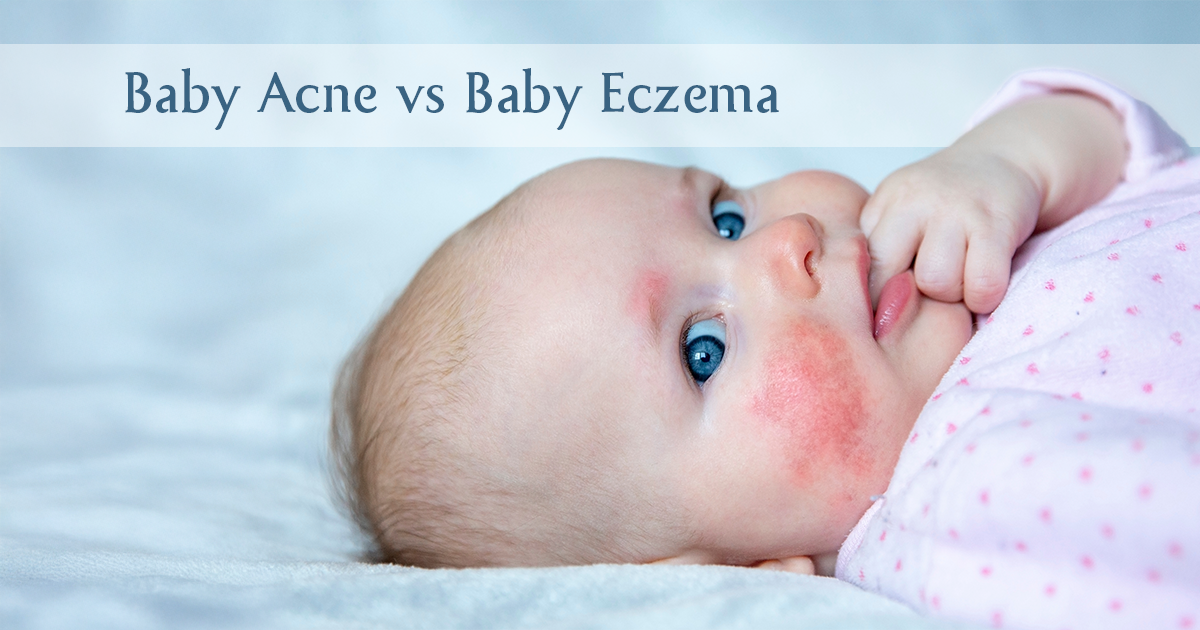 Baby acne vs baby eczema