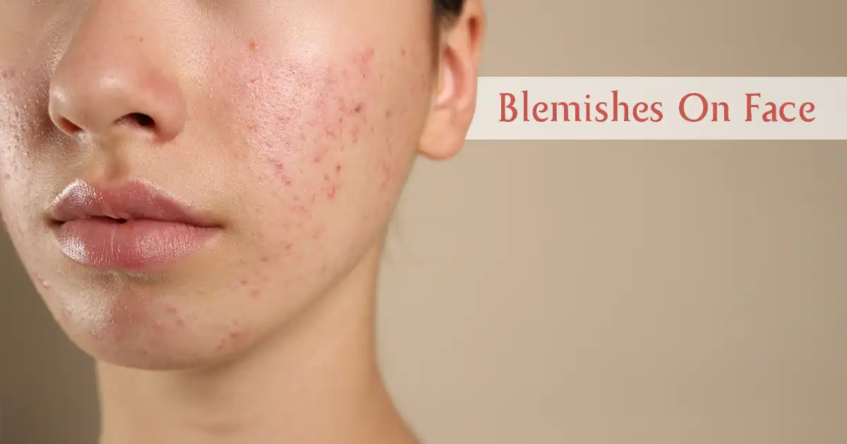 Blemishes on Face Explained: Real Causes and Natural Remedies You Can Trust
