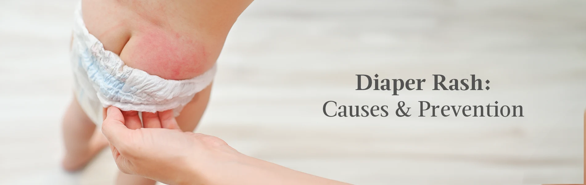 Understanding and Managing Diaper Rash: A Skin-Care Guide