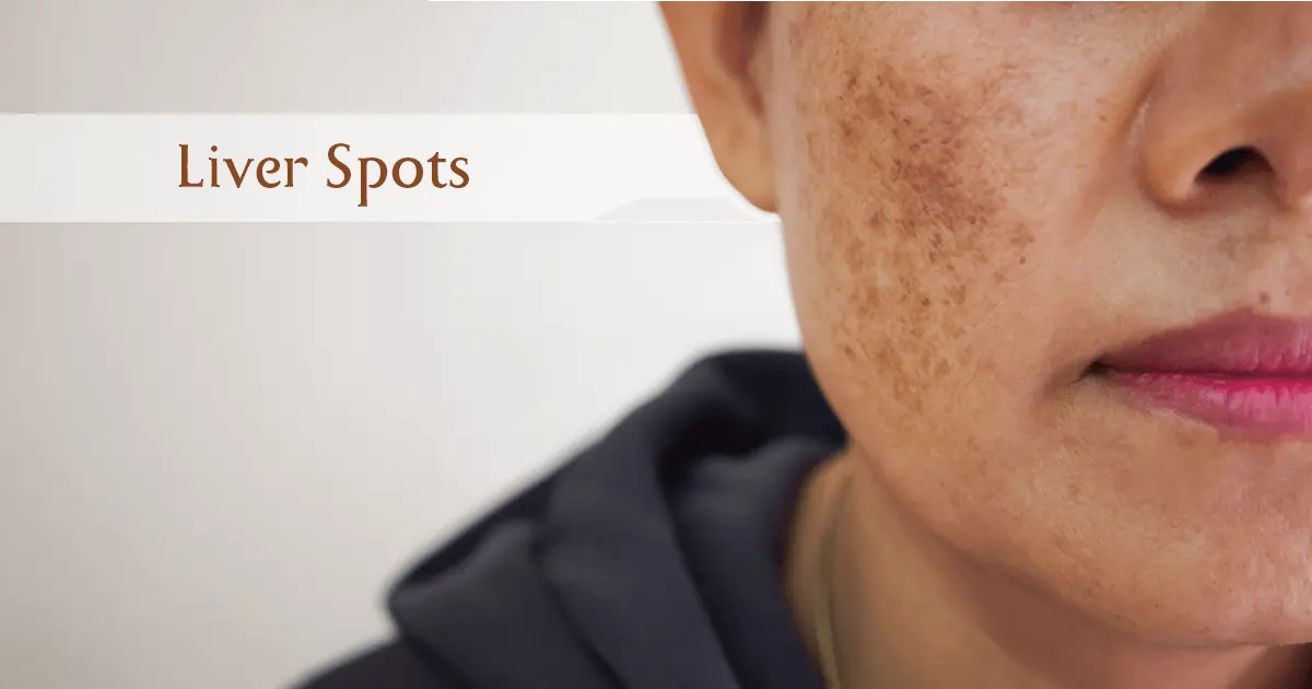 Liver spots