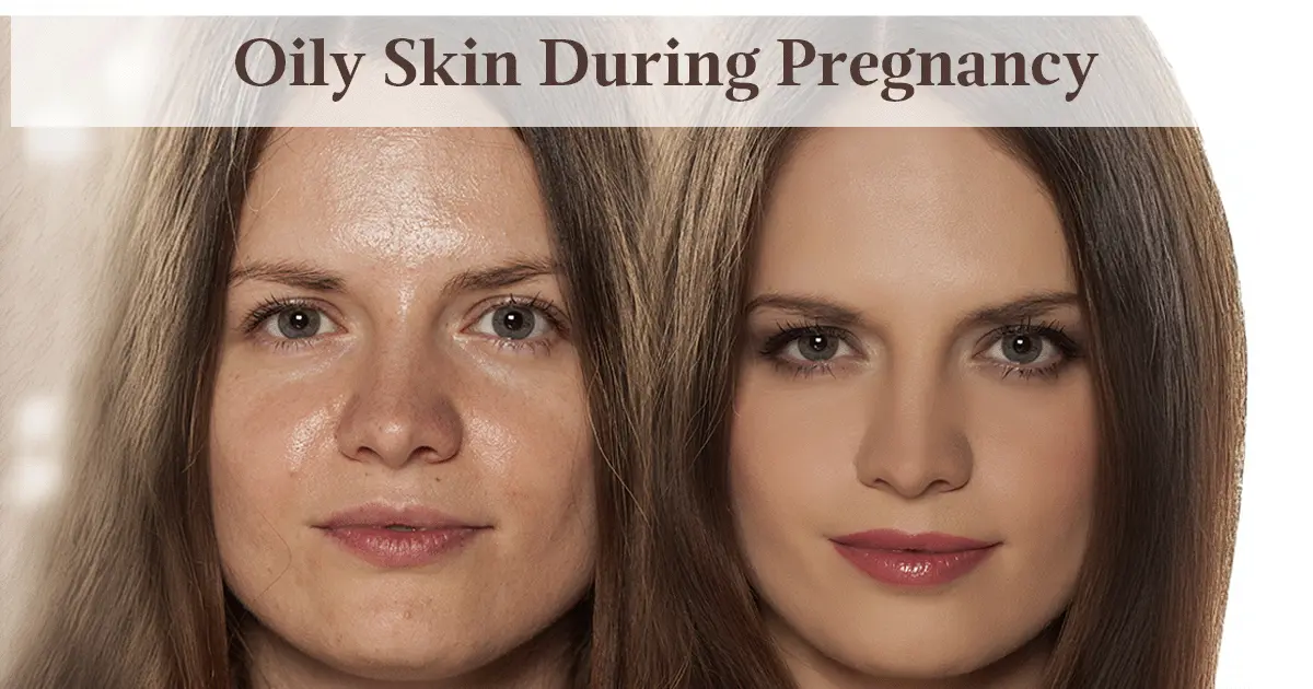 Oily Skin During Pregnancy - Causes & Prevention