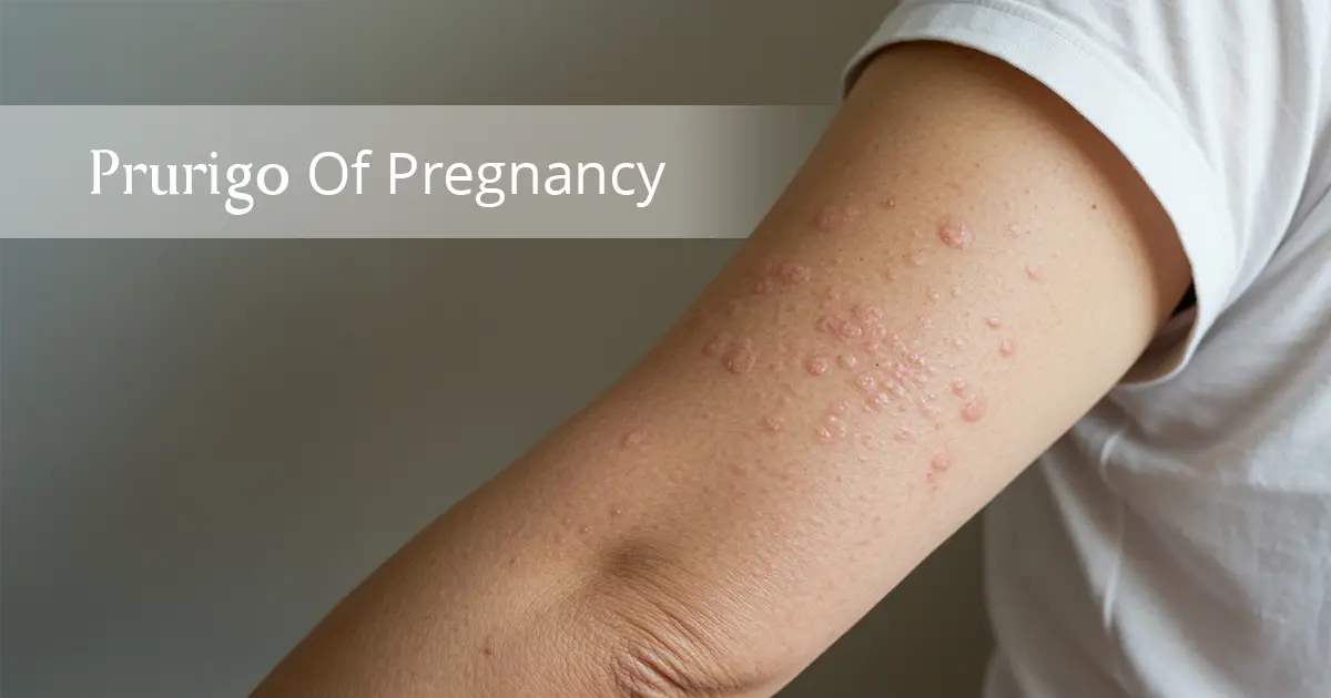 Understanding Prurigo Of Pregnancy: Causes, Risks & Management