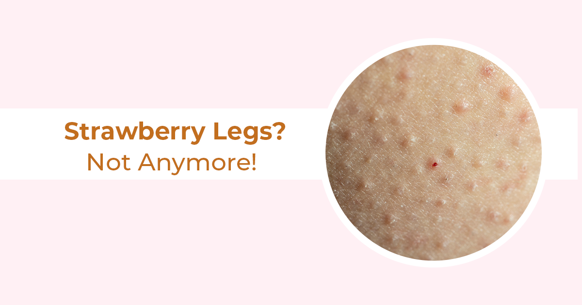 What Causes Strawberry Legs and How to Get Rid of Them – Tips Inside!