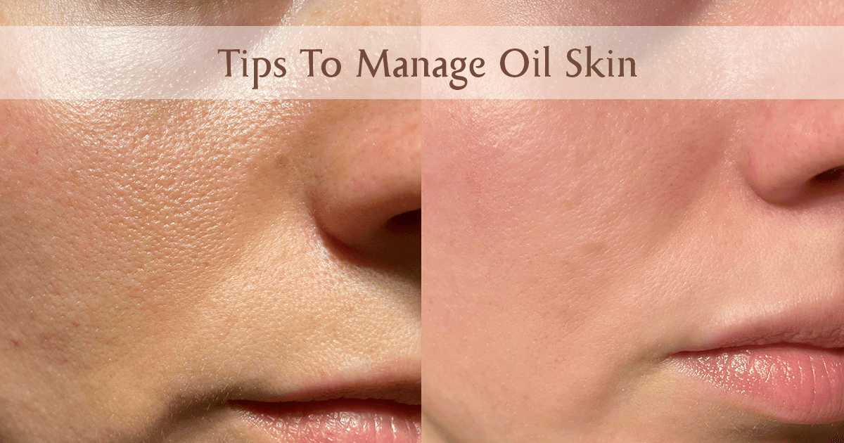 Tips To Manage Oil Skin