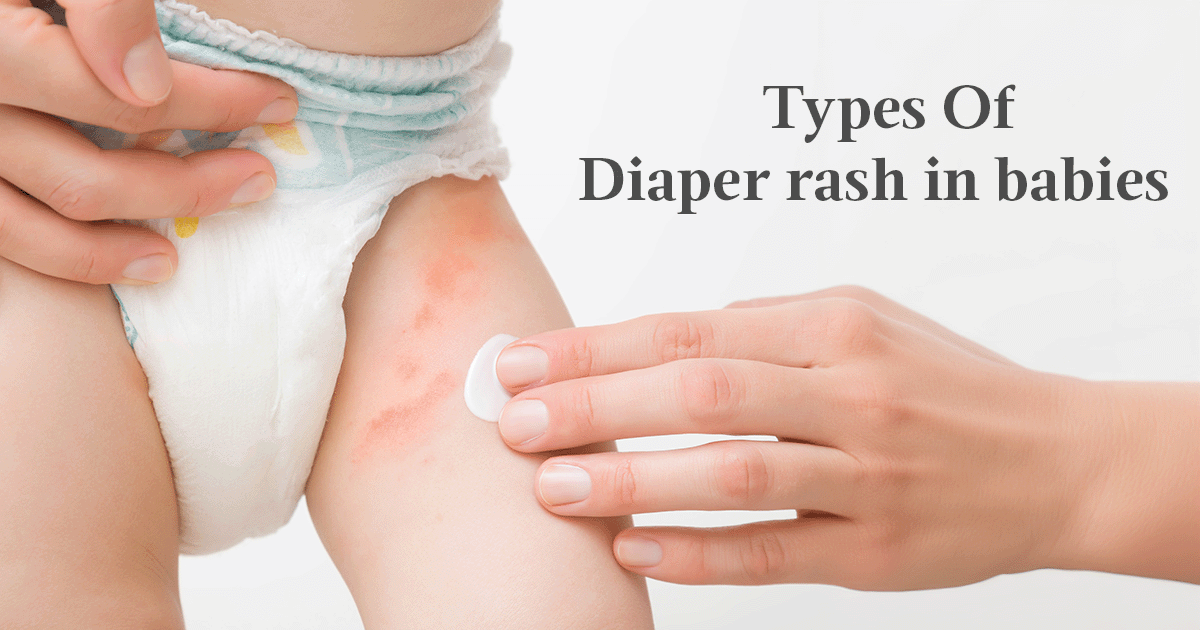 Types Of Diaper rash in babies