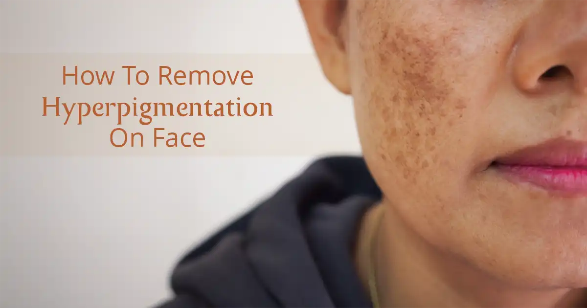 Hyperpigmentation On Face & Body: Causes & Effective Ways To Manage It