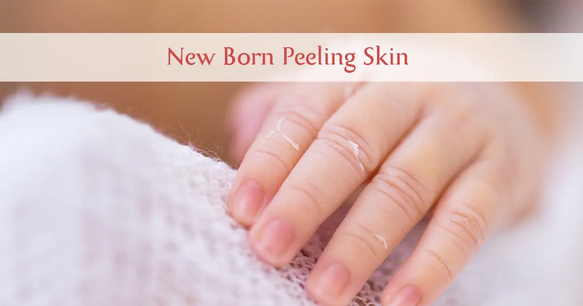 Newborn Peeling Skin