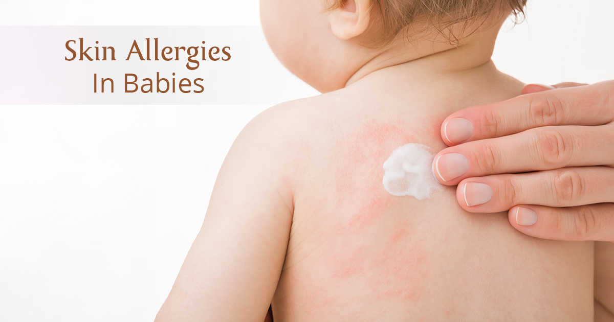 skin allergies in babies