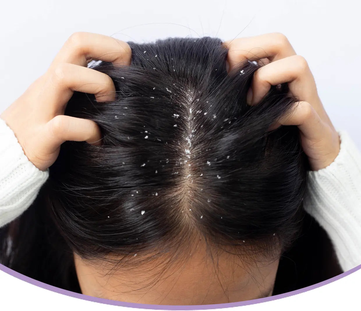 Dandruff Test Anti Dandruff Test – AreoVeda